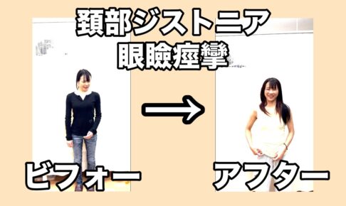 痙性斜頸　眼瞼痙攣　食いしばり　女性